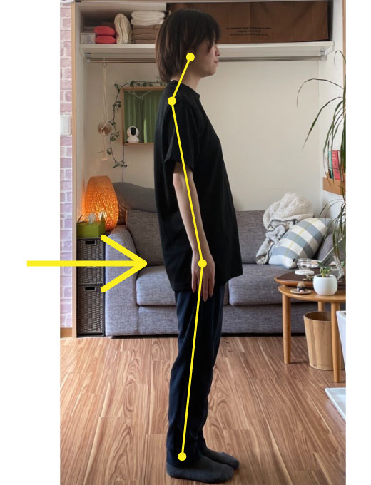 反り腰姿勢の施術前の姿勢写真